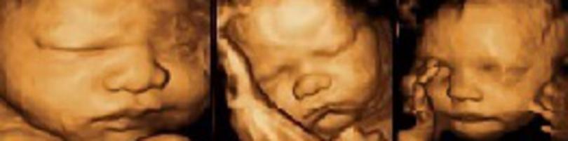 3D ultrasound Ohio header
