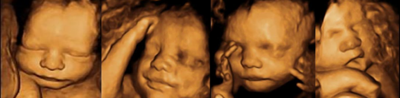 3D ultrasound Ohio header